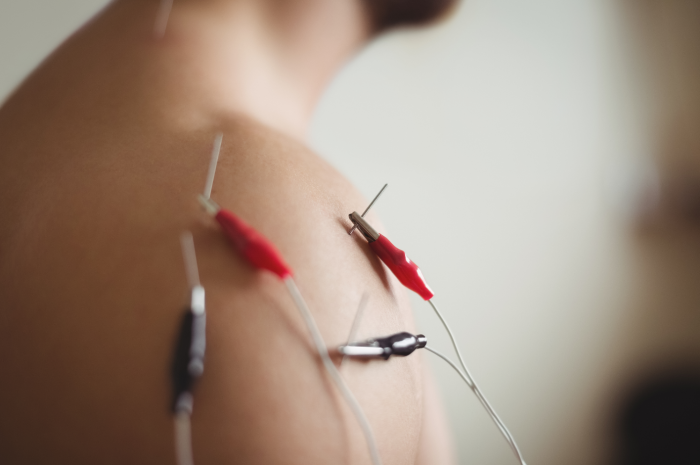 Electroacupuncture